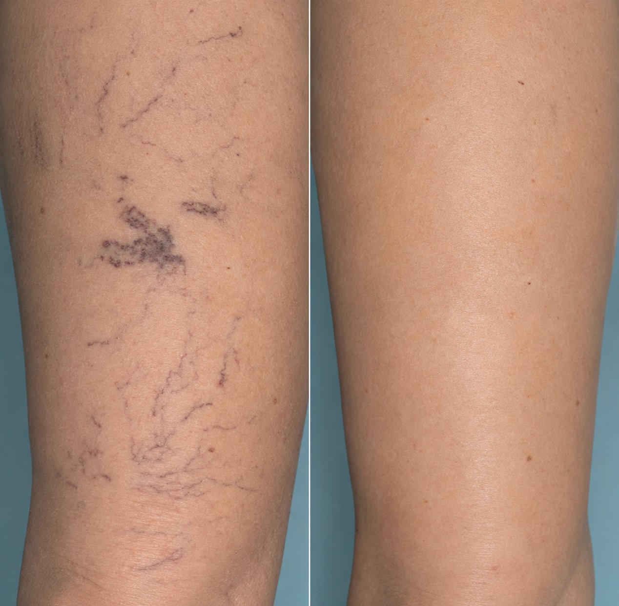 Before and after spider vein treatment Georgetown TX - sclerotherapy results Lone Star Vein Clinic